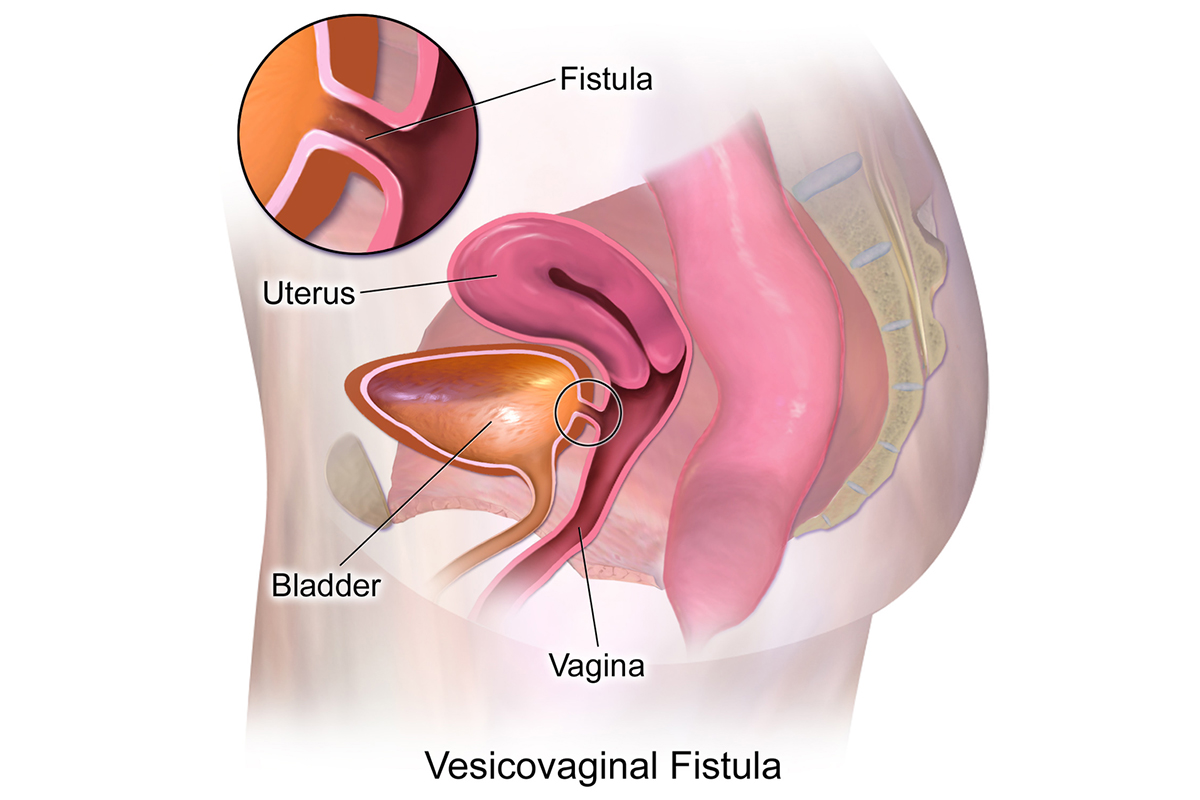 Read more about the article Vesicovaginal Fistula (VVF)