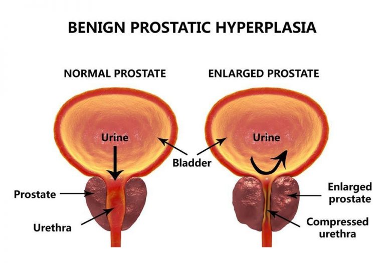 Prostate Enlargement Urologist Urohealth Medical Clinic 