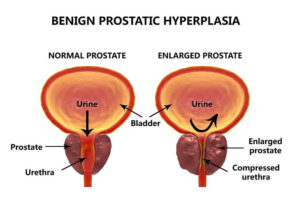 Read more about the article Prostate Enlargement (BPH)