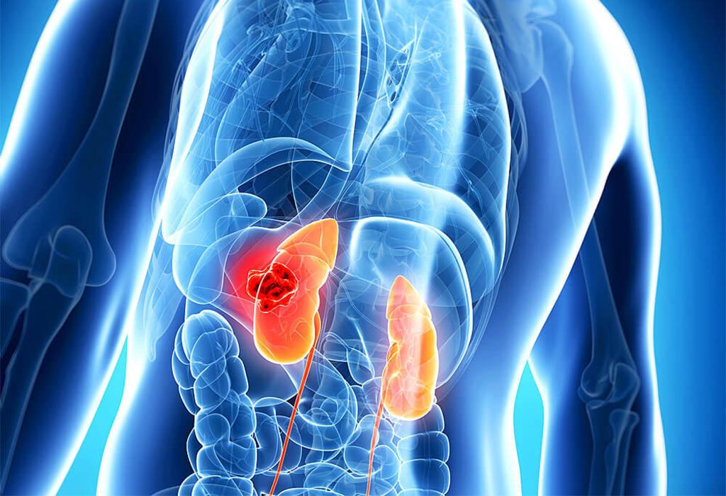 Read more about the article Kidney Cancer