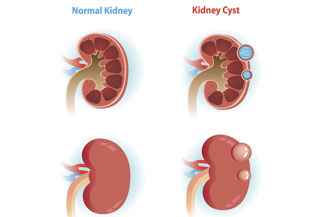 Read more about the article Renal Cysts