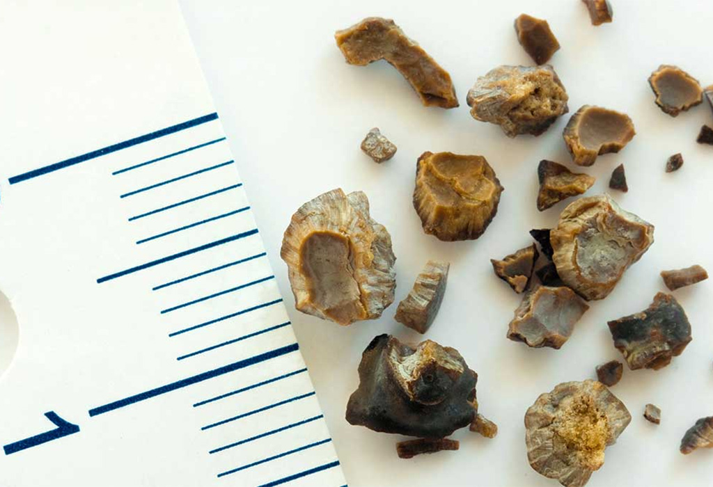 Read more about the article Kidney Stone Treatment