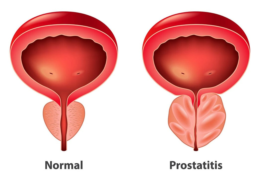 Read more about the article Prostatitis