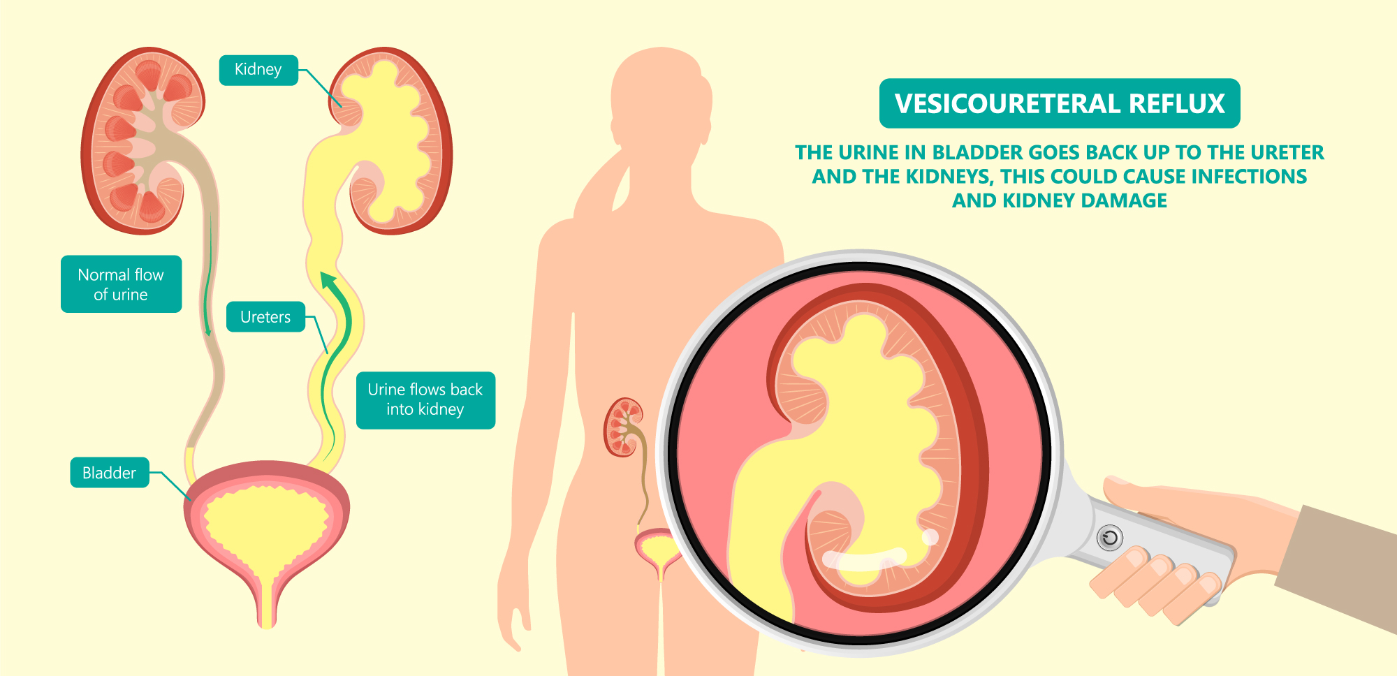 Read more about the article Vesicoureteral Reflux (VUR)