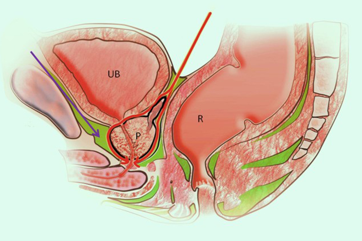 Read more about the article Robot-Assisted Radical Prostatectomy